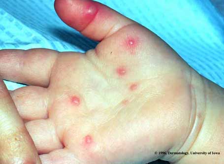 Hand, foot and mouth disease plagues college campuses