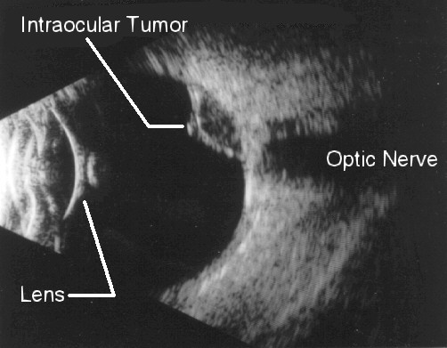Ultrasound, Intraocular tumor