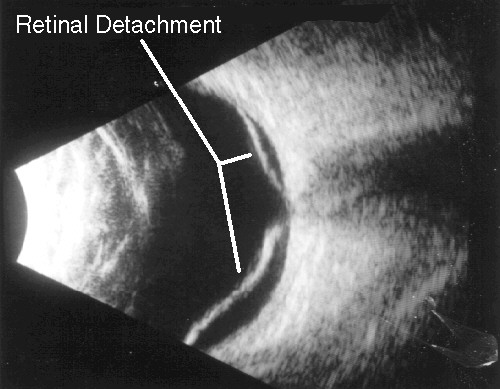 Ultrasound, retinal detachment
