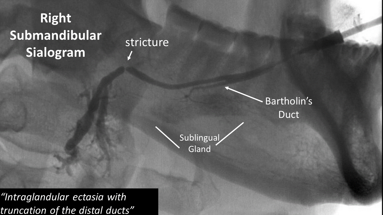 submandibular duct stricture with Bartholins duct present