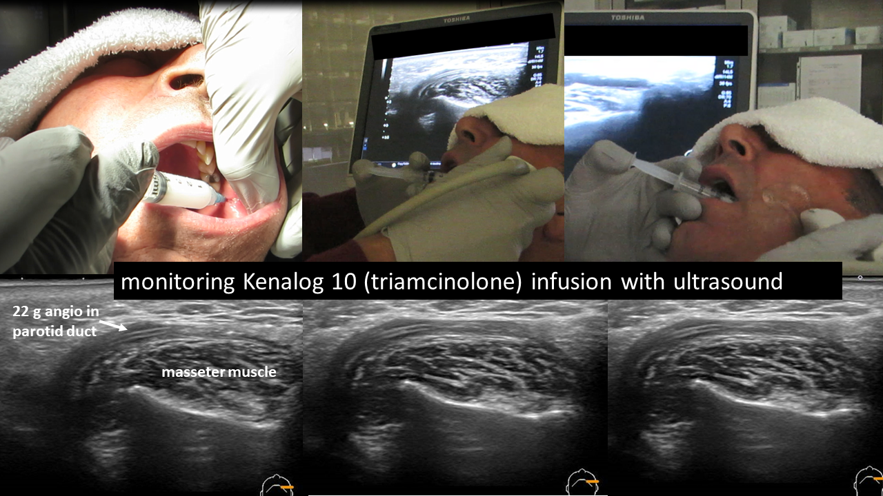 ultrasound sialography