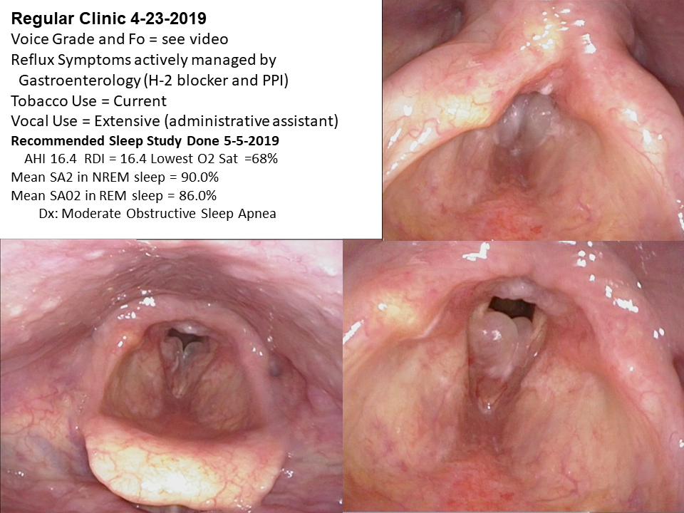 Dysphonia 2019 preop