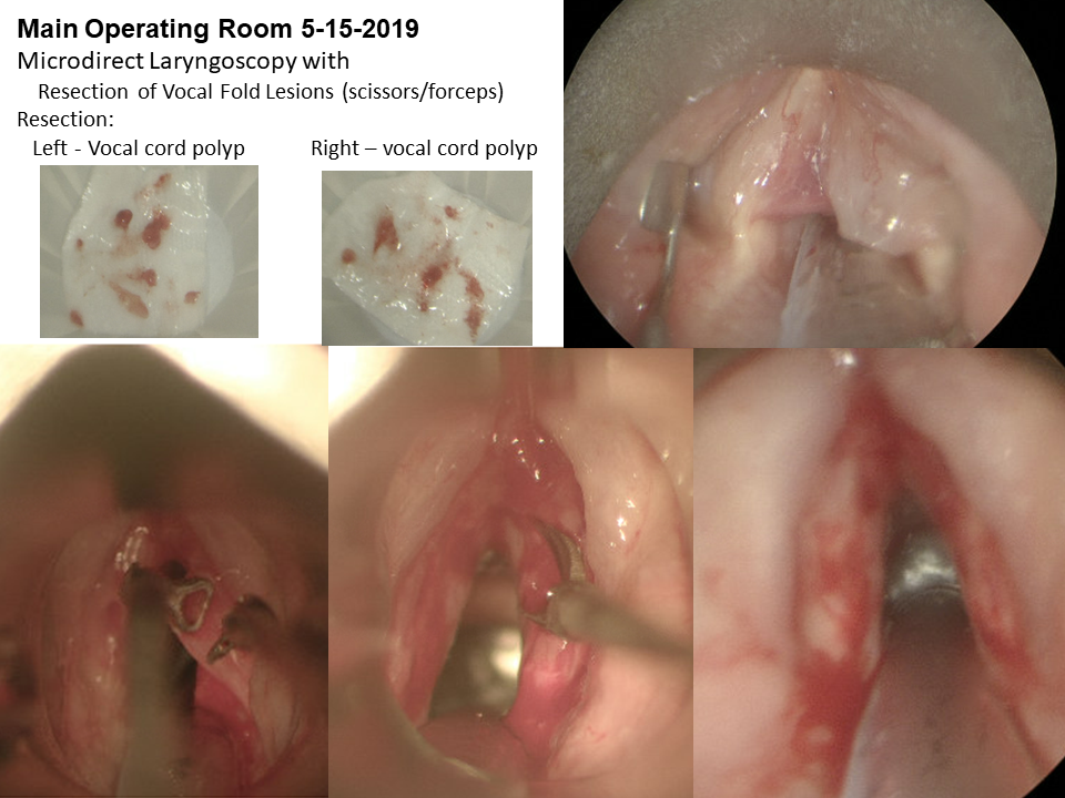 Dysphonia 2019 surgery