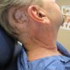Post-op day 10 after skin graft and posterolateral neck dissection