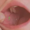 Right Parotid Papilla (Created by and used with permission from Hellerhoff)