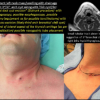 3rd 4th Branchial Cleft Cyst Fistula