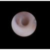 laser sialendoscopy for parotid stone