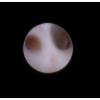 laser sialendoscopy for parotid stone