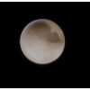 laser sialendoscopy for parotid stone
