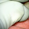 SMG cannulation with Prolene and 26 gauge angio