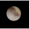 laser sialendoscopy for parotid stone