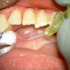 SMG cannulation with Prolene and 26 gauge angio