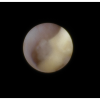 laser sialendoscopy for parotid stone