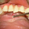 SMG cannulation with Prolene and 26 gauge angio