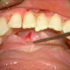 SMG cannulation with Prolene and 26 gauge angio