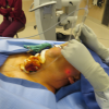 laser sialendoscopy for parotid stone