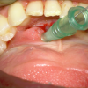 SMG cannulation with Prolene and 26 gauge angio