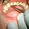 SMG cannulation with Prolene and 26 gauge angio