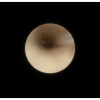SMG cannulation with Prolene and 26 gauge angio