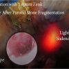 Parotid Sialendoscopy After Laser Lithotripsy