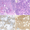 From "Application of Lip Biopsy for the Histological Diagnosis of Immunoglobulinavailable under the Creative Commons CC-BY-NC license and permits non-commercial use, distribution and reproduction in any medium, provided the original work is properly cited