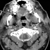 Lymphadenoma parotid