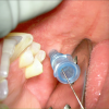 laser sialendoscopy for parotid stone