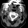 CT Parotid 4x5x4.4 mm stone   610 HU