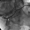 laser sialendoscopy for parotid stone
