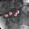 laser sialendoscopy for parotid stone