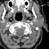 infusion of accessory lobe parotid sialography
