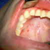 SMG cannulation with Prolene and 26 gauge angio