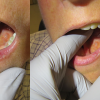 floor of mouth mucus retention cyst with rupture (mucus extravasation phenomenon).
