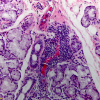 Inflammation in Sjogren syndrome can be centered around vessels as seen here