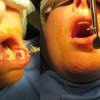 minor salivary gland biopsy of lip using chalazion clamp