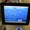 laser sialendoscopy for parotid stone