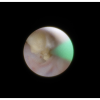 laser sialendoscopy for parotid stone