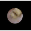 laser sialendoscopy for parotid stone