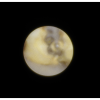 laser sialendoscopy for parotid stone