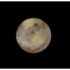 laser sialendoscopy for parotid stone