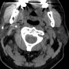 CT Parotid 4x5x4.4 mm stone   610 HU