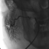 laser sialendoscopy for parotid stone
