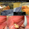 Parotid Sialodochoplasty Surgical Exposure - for Salivary Stone Removal