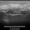 infusion of accessory lobe parotid sialography
