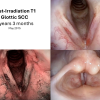 T1 post XRT long term sequence