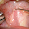 SMG cannulation with Prolene and 26 gauge angio