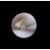 laser sialendoscopy for parotid stone
