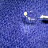 laser sialendoscopy for parotid stone