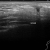 Lymphadenoma parotid