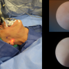 Parotid Sialodochoplasty Surgical Exposure - for Salivary Stone Removal